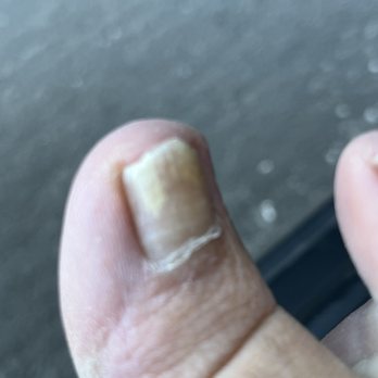 Kendra's Spa - Toe fungus a la Kendra. - Nail Salons Near Me - Menlo Park, California