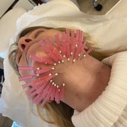 Fountain Hills MedSpa - PDO threads