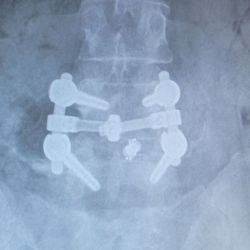 Tiffany Rogers, MD, MPT - Interbody disc fusion