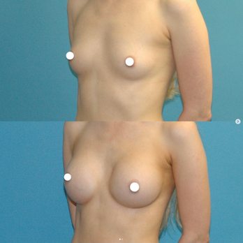 Sound Plastic Surgery - Breast Augmentation surgery with Sound Plastic Surgery - Cosmetic Surgeons Near Me - Seattle, Washington