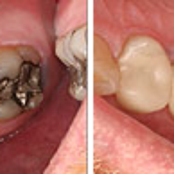 Nathan E Vick - Restoring old, failing, silver fillings in a single appointment using CEREC technology
