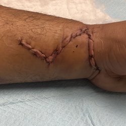 Arizona Center for Hand to Shoulder Surgery - Poor stitch work