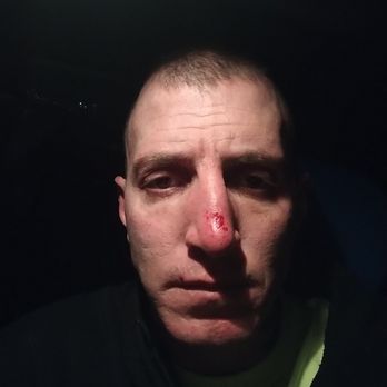 Sundown Mountain - This is the aftermath of my nose - Ski Resorts Near Me - Dubuque, Iowa Sundown Mountain - This is the aftermath of my nose - Ski Resorts Near Me - Dubuque, Iowa
