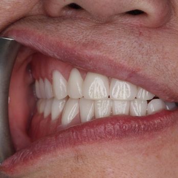 Bespoke Denture Clinic - Complete denture upper and lower - General Dentistry Near Me - Victoria, British Columbia Bespoke Denture Clinic - Complete denture upper and lower - General Dentistry Near Me - Victoria, British Columbia