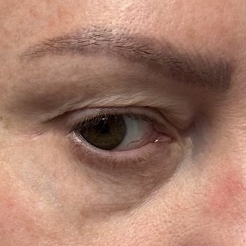 Joon Y Choi, MD - My ugly before no lashes day of surgery - Medical Spas Near Me - Orange, California