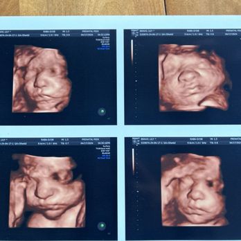 Prenatal Peek - Baby girl at 31 weeks a little shy and annoyed we wanted her to move her feet and hand away from her face - Ultrasound Imaging Centers Near Me - Santa Rosa, California Prenatal Peek - Baby girl at 31 weeks a little shy and annoyed we wanted her to move her feet and hand away from her face - Ultrasound Imaging Centers Near Me - Santa Rosa, California