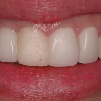 Ellis Wong, DDS - my veneers from BEFORE DR. WONG from previous dentist (the yellow tooth was a temporary) - General Dentistry Near Me - Los Angeles, California Ellis Wong, DDS - my veneers from BEFORE DR. WONG from previous dentist (the yellow tooth was a temporary) - General Dentistry Near Me - Los Angeles, California