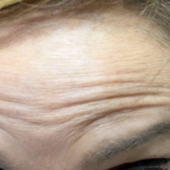 Flawless Reflections Body and Skin Therapy - Full movements of bottom half of my forehead after a month treatment. - Medical Spas Near Me - Mesa, Arizona