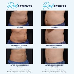 New Radiance Ft Lauderdale - CoolSculpting Real Results - Our Real Results Promise