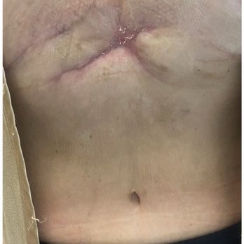 Scultura Plastic Surgery - Remaining scar a year and a half post op. - Plastic Surgeons Near Me - Newport Beach, California Scultura Plastic Surgery - Remaining scar a year and a half post op. - Plastic Surgeons Near Me - Newport Beach, California