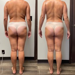 Love Your Body - 10 sessions of Endospheres therapy .