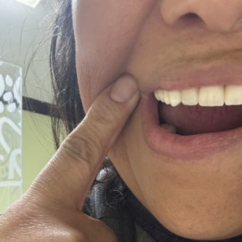 Affordable Dental - The bridge and front teeth don't align. The bridge permanently has fallen out 3x, the other tooth fell out. I paid $2000 just to fix that. - Cosmetic Dentists Near Me - Van Nuys, California Affordable Dental - The bridge and front teeth don't align. The bridge permanently has fallen out 3x, the other tooth fell out. I paid $2000 just to fix that. - Cosmetic Dentists Near Me - Van Nuys, California