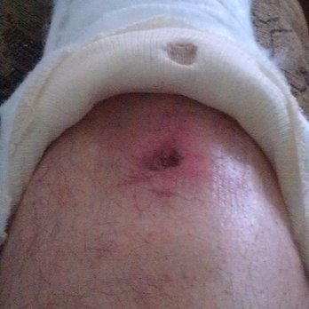 Triad Foot & Ankle Center - Excruciating shin injury due to a poorly applied cast, exacerbated by the post-op applied local nerve block. - Podiatrists Near Me - Burlington, North Carolina Triad Foot & Ankle Center - Excruciating shin injury due to a poorly applied cast, exacerbated by the post-op applied local nerve block. - Podiatrists Near Me - Burlington, North Carolina