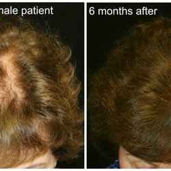 Hair Transplant Specialists - PRP - Before & After