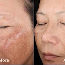 Glowing Skin Med Spa - Before and After Cosmelan Treatment for Melasma.