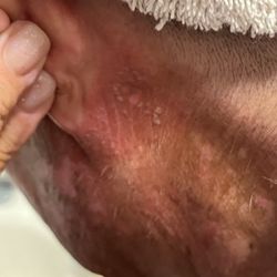 Beacon Medical Group Dermatology Ireland Road - Where the fleas bit, my ears, and my body.