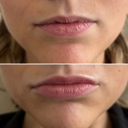Atelier Medical Aesthetics - HA dermal fillers can hydrate the lips from within. The after picture is taken immediately post treatment
