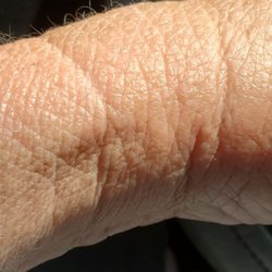 Menifee Family Acupuncture - Where 1 needle was in my hand... instantly swollen, she said it's not swollen, I know my body.. it's sore and swollen.