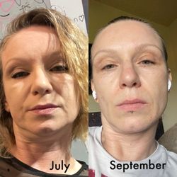 Before and after, Botox and skincare products.