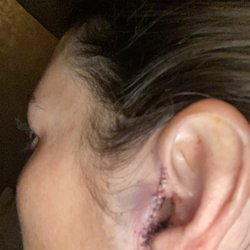 Mark L Glyman, MD DDS FACS - Incision for tumor removal
