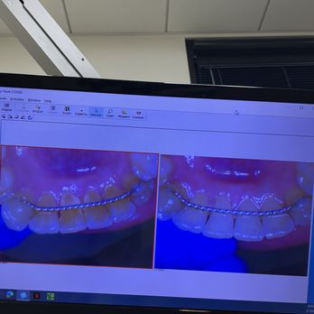 Ethos Advanced Dental Care - Before & after cleaning with Nelia - General Dentistry Near Me - Temecula, California Ethos Advanced Dental Care - Before & after cleaning with Nelia - General Dentistry Near Me - Temecula, California