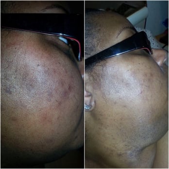 Pretty Faces Skintique - Treating Hyperpigmentation - Skin Care Near Me - Houston, Texas Pretty Faces Skintique - Treating Hyperpigmentation - Skin Care Near Me - Houston, Texas