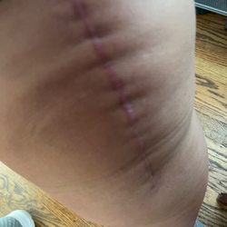 Patrick McGahan, MD - My beautiful scar of my left knee replacement! 2months post op