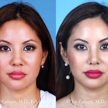 Dr Jay Calvert Plastic Surgery - Asian Rhinoplasty by Dr Jay Calvert - Cosmetic Surgeons Near Me - Newport Beach, California Dr Jay Calvert Plastic Surgery - Asian Rhinoplasty by Dr Jay Calvert - Cosmetic Surgeons Near Me - Newport Beach, California