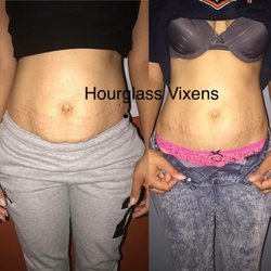 Hourglass Vixens - Before & after 3 laser lipo sessions