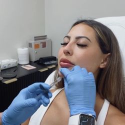 Botoxicated - Chin filler