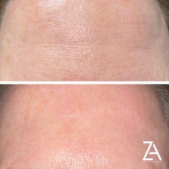 Zaretsky Aesthetics - RF Microneedling - Medical Spas Near Me