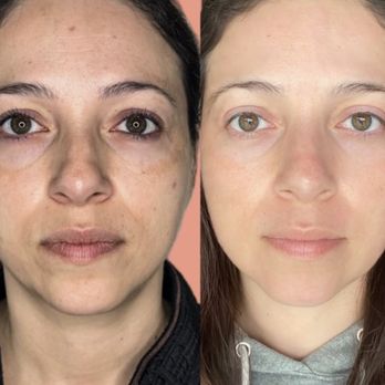 PBN Aesthetics - Fibroblast results after one session - Estheticians Near Me PBN Aesthetics - Fibroblast results after one session - Estheticians Near Me