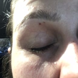 Two cut marks from yesterday's eyebrow threading session. Two cut marks from yesterday's eyebrow threading session.