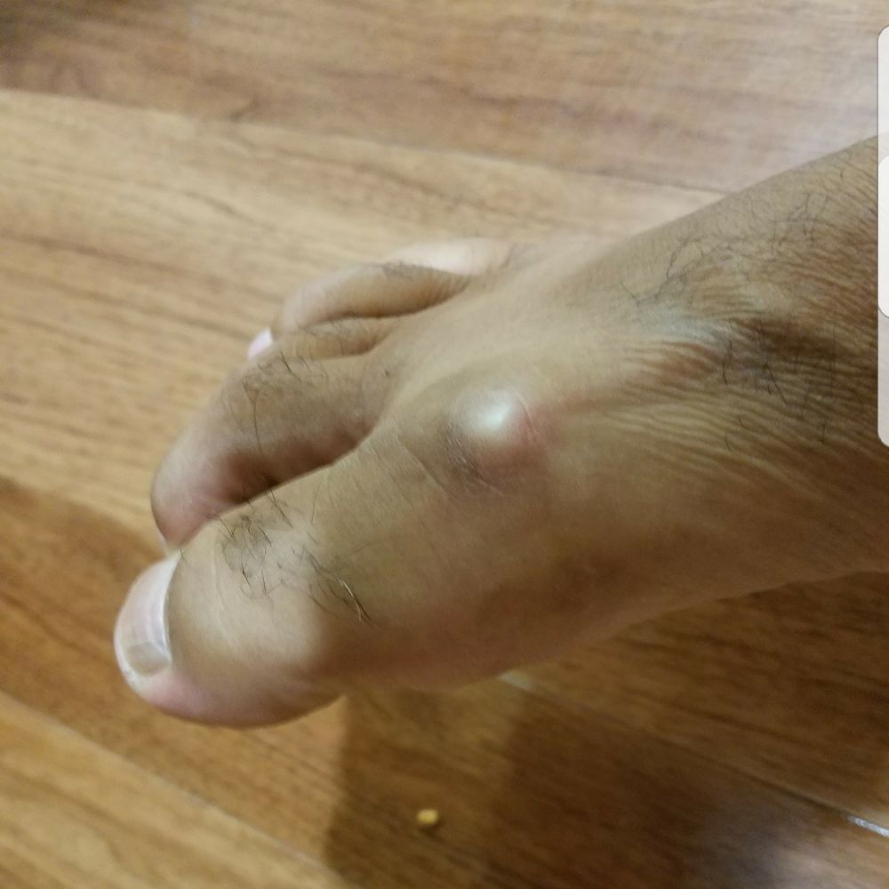 Gregory Morris, DPM - Before the operation. - Podiatrists Near Me - Honolulu, Hawaii
