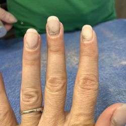 Creative Nail Design & Spa - Nail fungus.