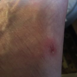Side of foot with abrasion Side of foot with abrasion