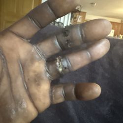 Budget Inn - My cut up two fingers that I will never be able to use for the rest of my life