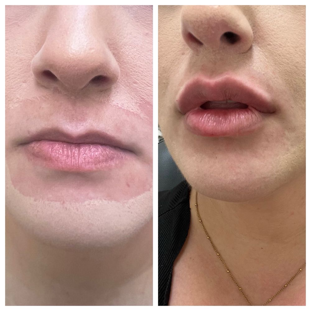 Mirako Spa - This is after 2 rounds of filler. Before is left after is right. - Medical Spas Near Me - Brea, California Mirako Spa - This is after 2 rounds of filler. Before is left after is right. - Medical Spas Near Me - Brea, California