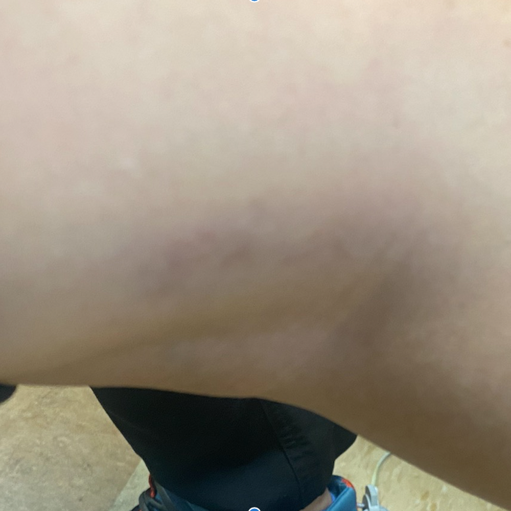 Bared Monkey Laser Spa - After 1 session - Laser Hair Removal Near Me - New York, New York Bared Monkey Laser Spa - After 1 session - Laser Hair Removal Near Me - New York, New York