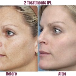 DrSkin Med Spa - Sun spots, age spots, and pigment; here today and gone tomorrow!! Fantastic results in just 2 treatments!!