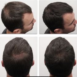 National Hair Loss Medical Aesthetics - 6months on our hair recovery program
