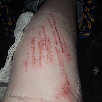 Red Top Rd Power Market - Damage to leg from injury - Gas Stations Near Me - Fairfield, California