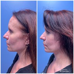 Cosmetic Plastic Surgery & Wellness Club - Left is PRE-surgery for deep plane facelift and neck lift. Right is 1-year POST surgery. No difference.