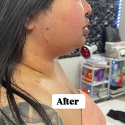 Body Couture And Beauty - After Velashape Chin Reduction Book Your Appointment Today