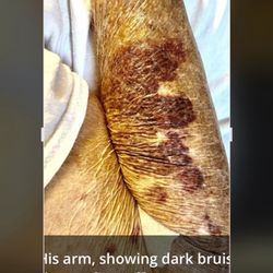 Watermere At Southlake - Bruises on a patient's arm (Nov 17, 3024) done by an aide with a very strong aide. Thid may be the result of unnecessarily rough treatment.