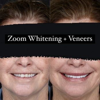 Image LA Dental Photo Studio - This patient did not like her stained and worn down teeth. - Cosmetic Dentists Near Me - Studio City, California Image LA Dental Photo Studio - This patient did not like her stained and worn down teeth. - Cosmetic Dentists Near Me - Studio City, California