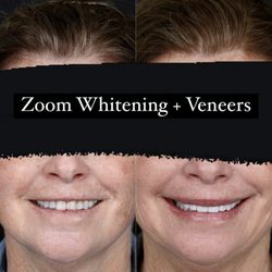 Image LA Dental Photo Studio - This patient did not like her stained and worn down teeth.