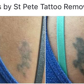 St Pete Tattoo Removal - After 2 treatments - Tattoo Removal Near Me - Pinellas Park, Florida