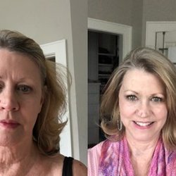 The Total You Medical Spa - PDO Threads Before and After