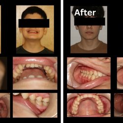 Olmos Park Dental - Before After Images 4